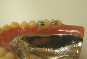 �����ꎕ�Ƀ��^���u���[�h�𑕒�