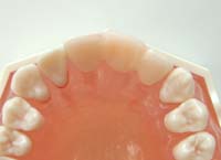 �E�C���O�A�^�b�`�����g�̓��ꎕ�E�ڒ��u���b�W�E�����s�`�斃�z�\��